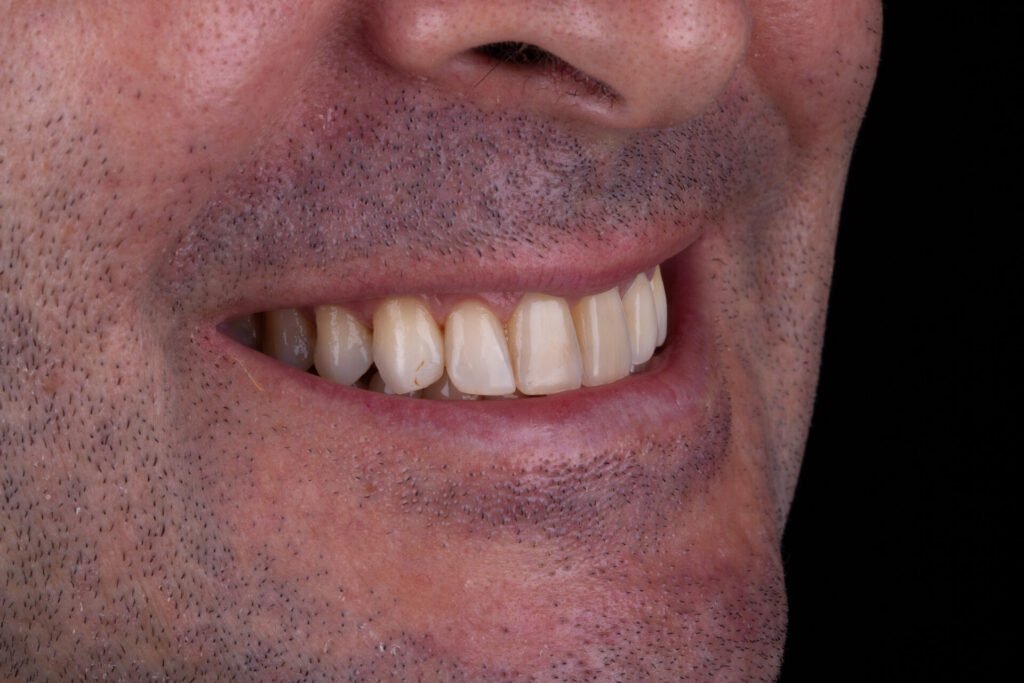 antes Lente de Contato Dental 