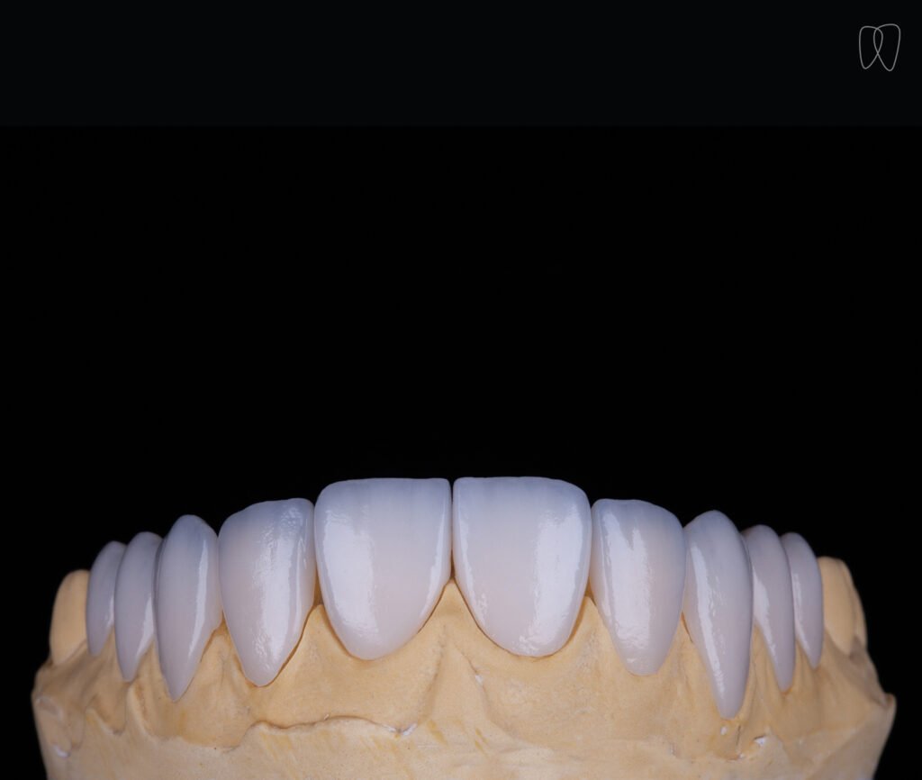Lente de Contato Dental superior