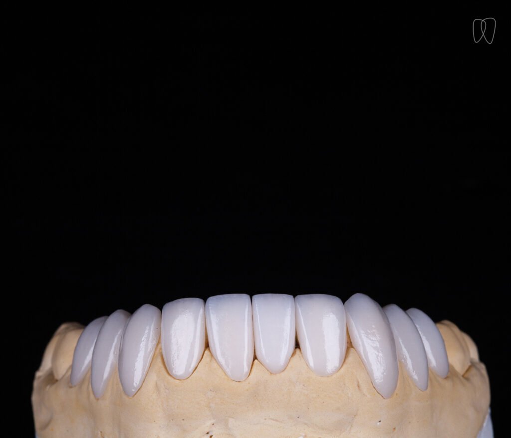 Lente de Contato Dental inferior