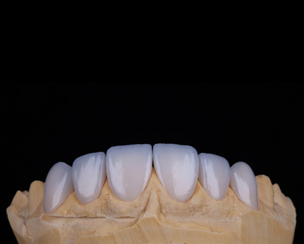 Lente de Contato Dental Modelo