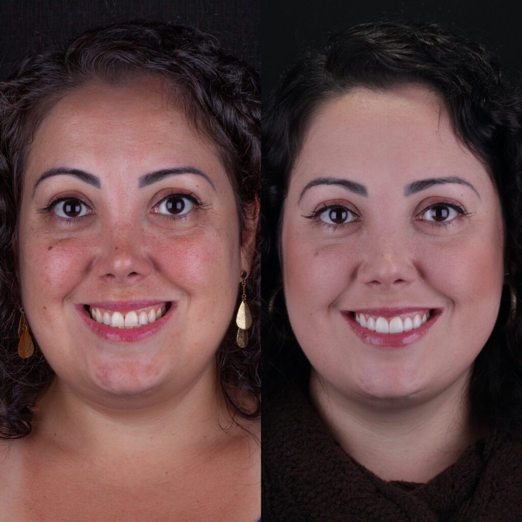 lente de contato dental juliana