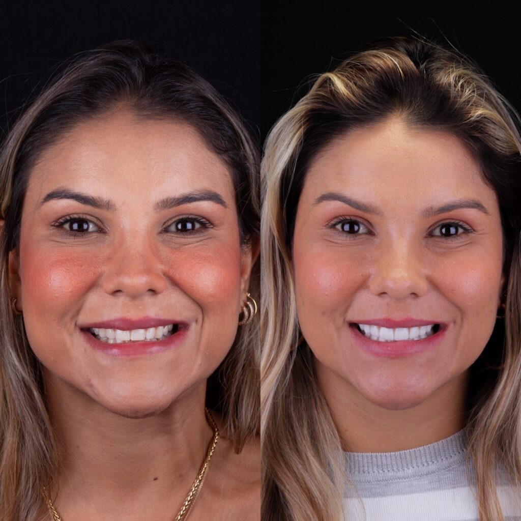 lente de contato dental suelen