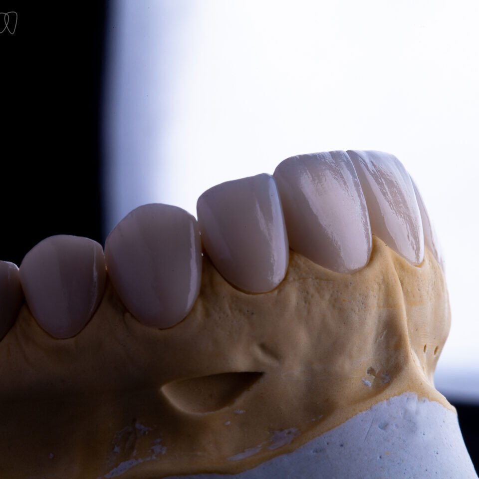 Tratamento de canal x lente de contato dental: quando é necessário?