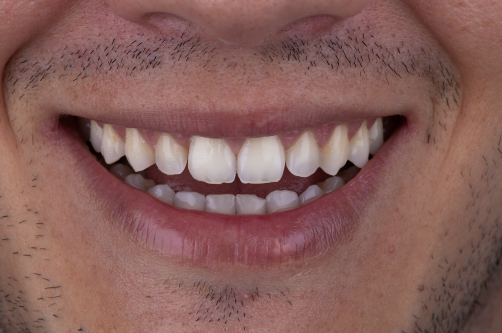 antes Felipe Lente de Contato Dental Antes e Depois