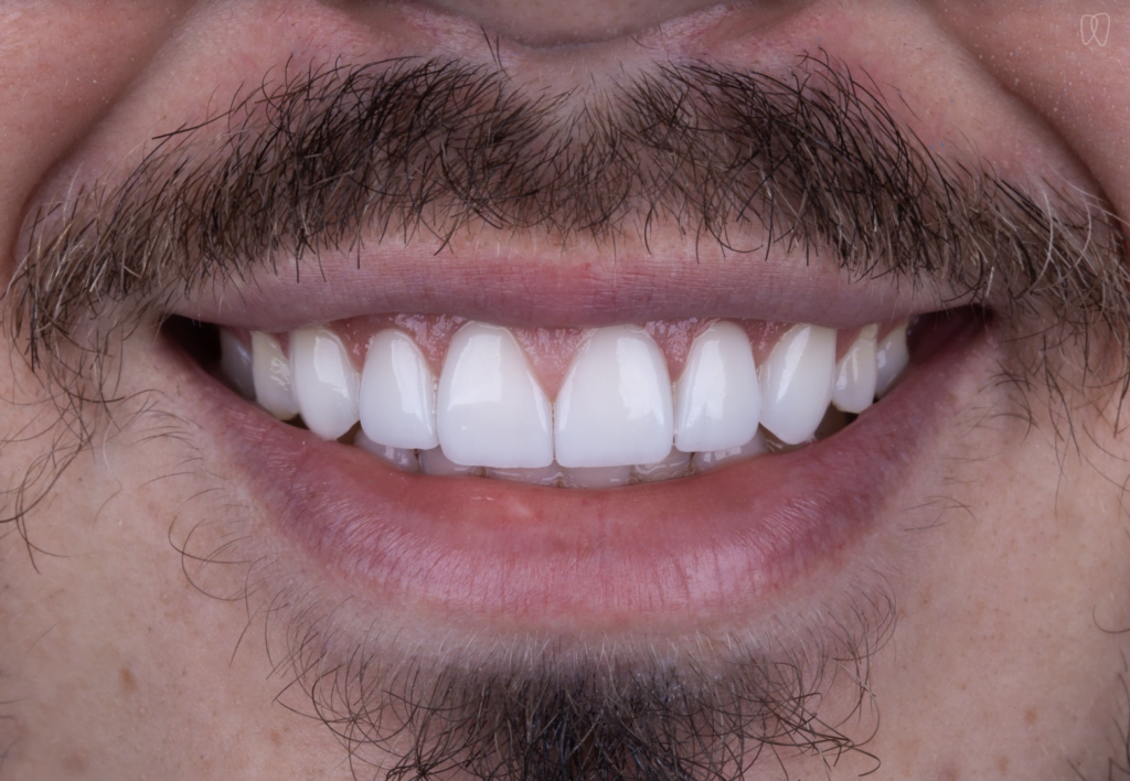 Tyler Lente de Contato Dental depois