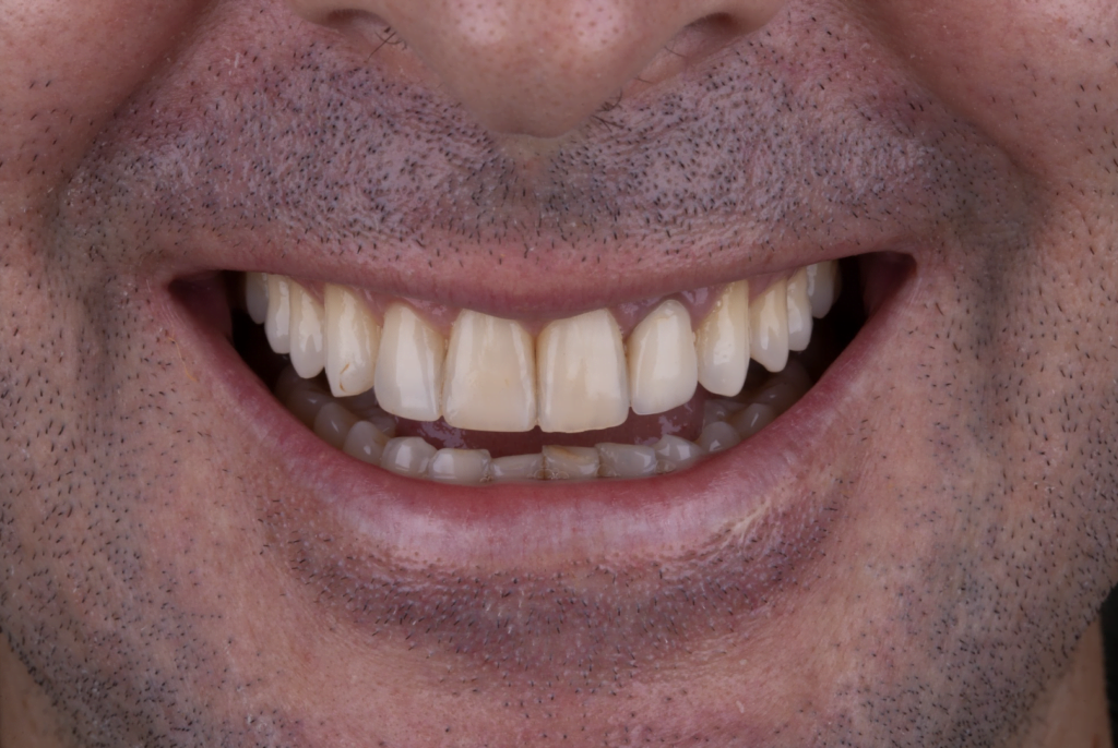 bernardo Lente de Contato Dental Antes 