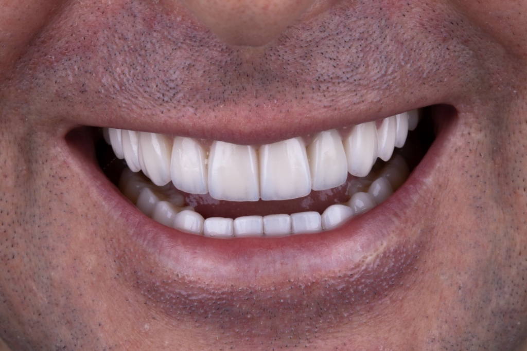 bernardo Lente de Contato Dental Depois