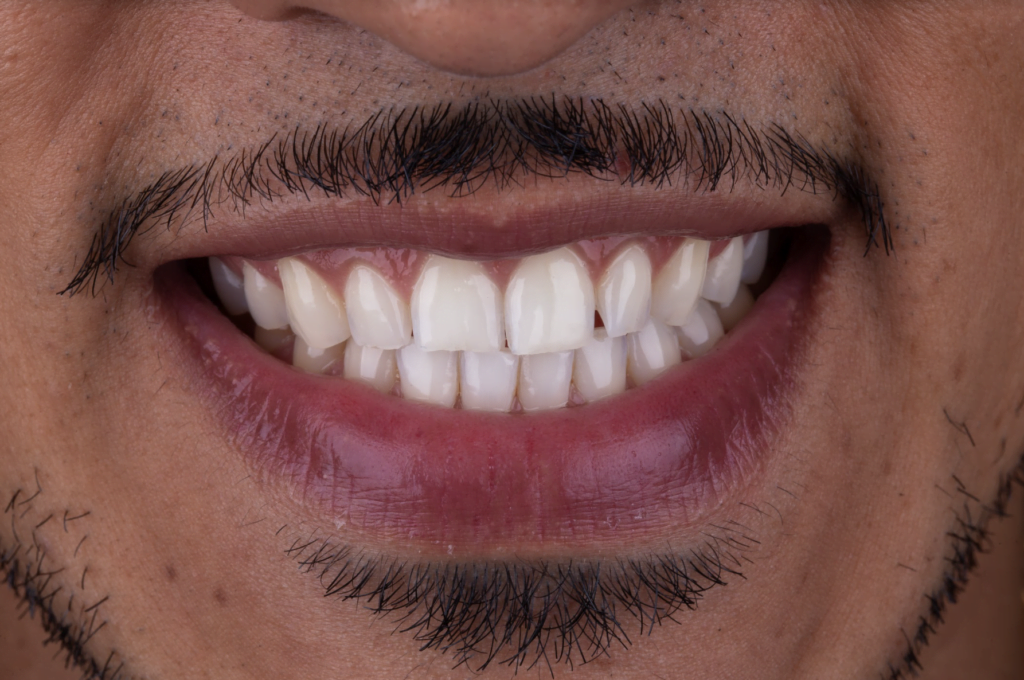 Lente de Contato Dental Antes e Depois bl1