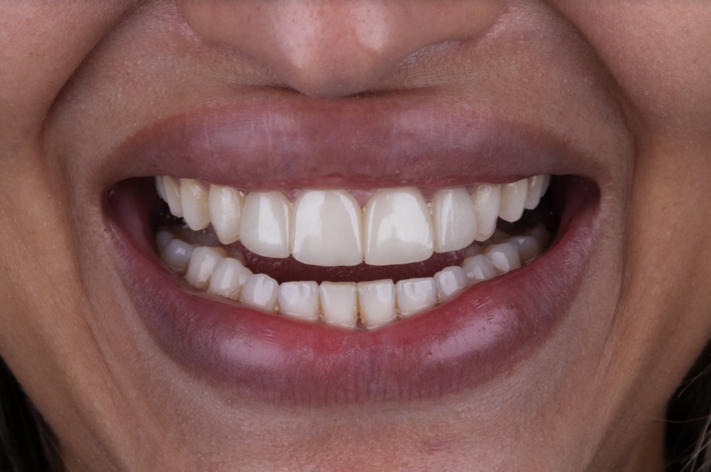 catarina Lente de Contato Dental Antes 