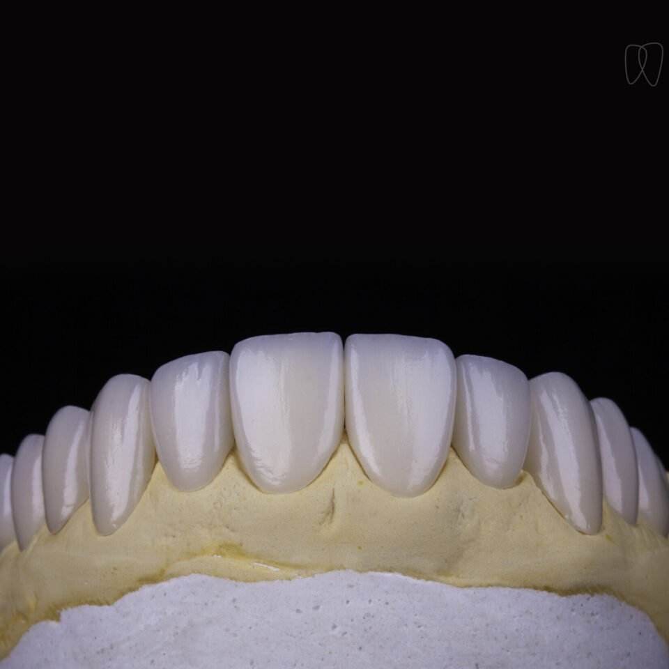 Faceta de resina ou porcelana? Qual escolher