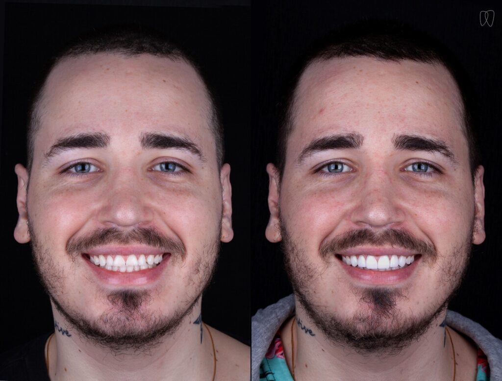 lente de contato dental tyler