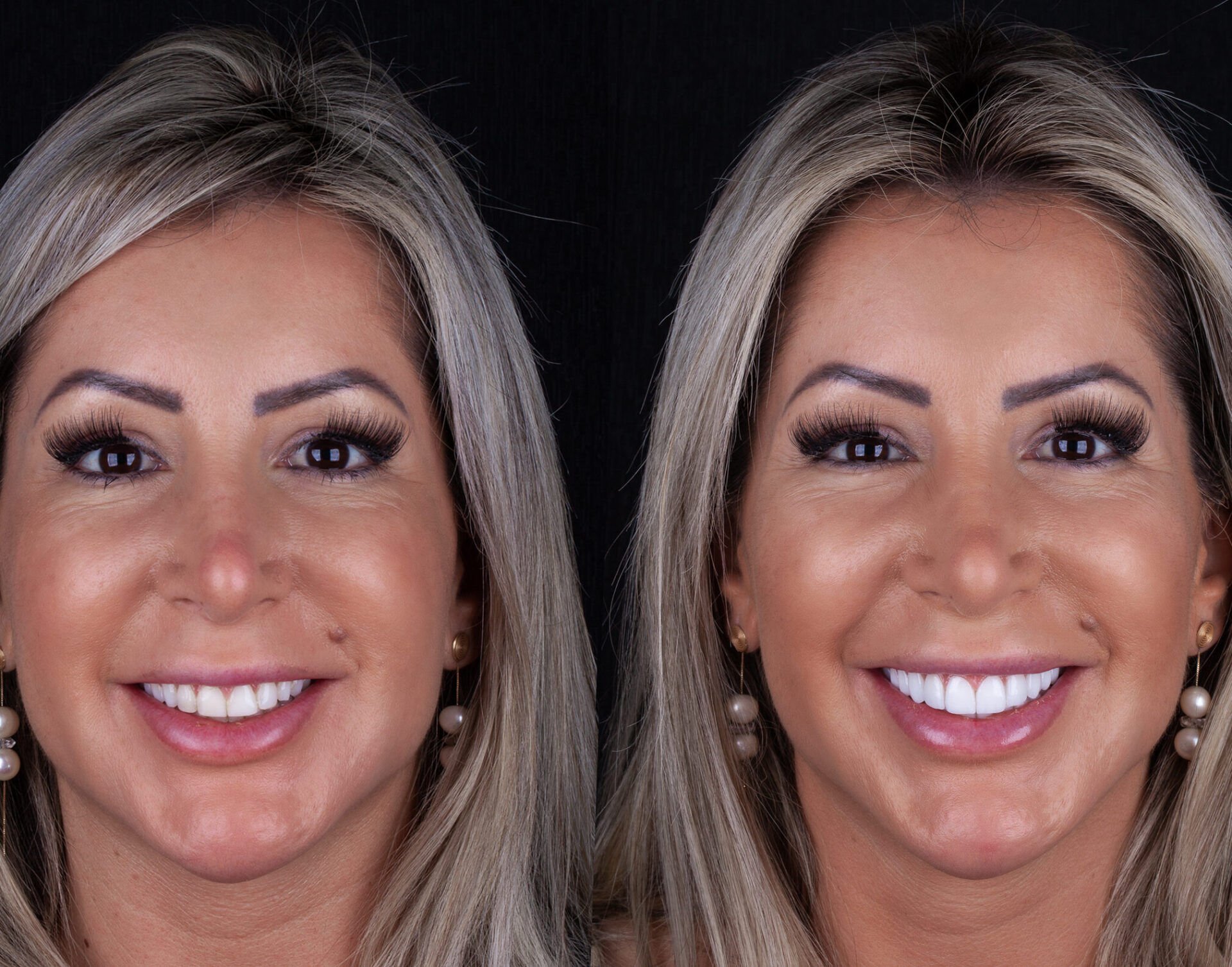 lente de contato dental Andressa