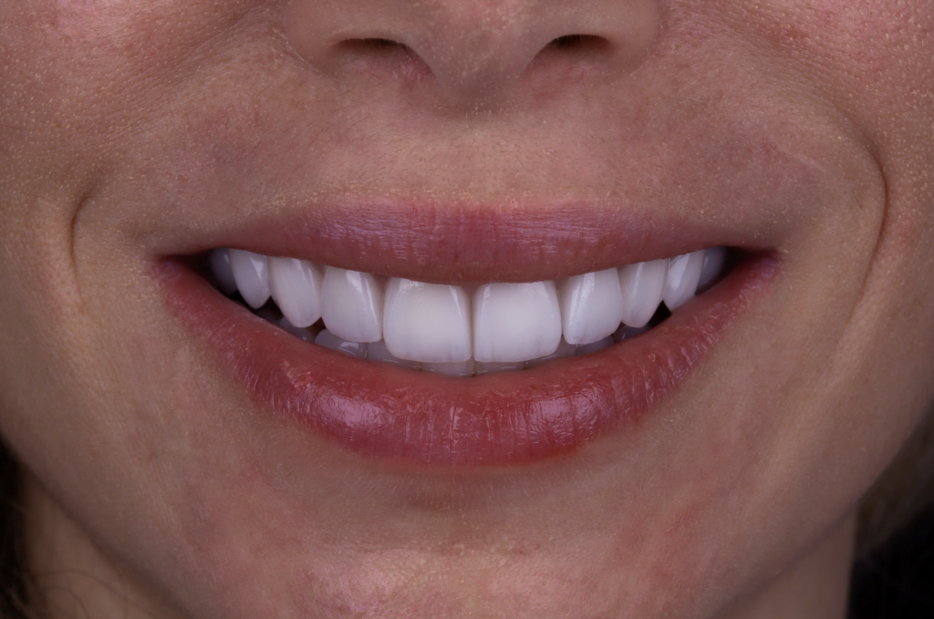 depois Lente de Contato Dental 