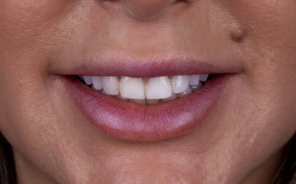 antes Andressa Lente de Contato Dental 