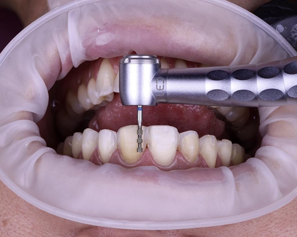 passo a passo lente de contato dental desgaste