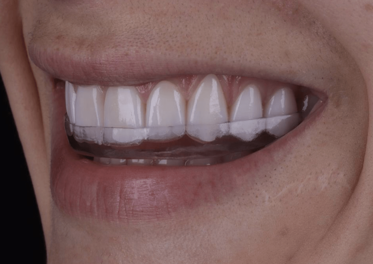 lente de contato dental e placa de bruxismo