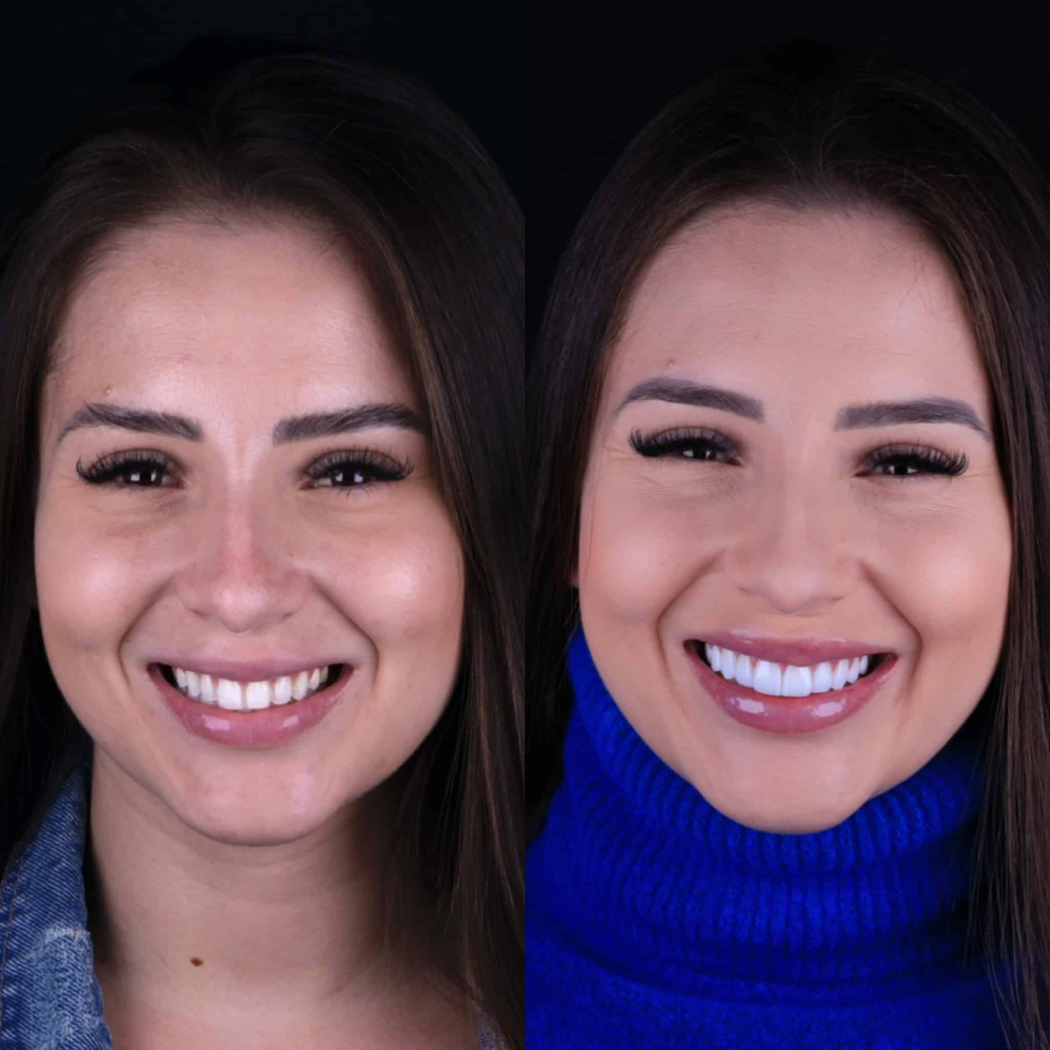 lente de contato dental antes e depois