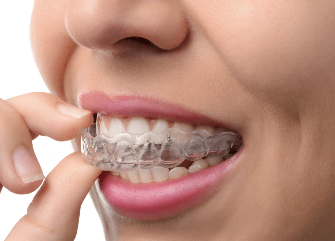 moldeira de Clareamento dental caseiro
